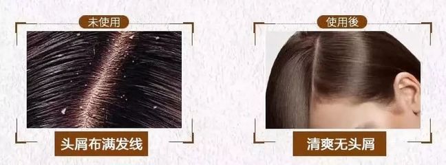 告別脫發、頭皮屑與頭發稀少的煩惱，重塑烏黑濃密的秀發